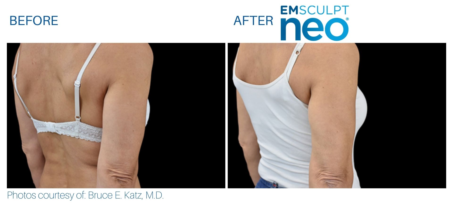 Optimum Emsculpt Neo Before And After Results On The Triceps Of A Woman'S Arms.