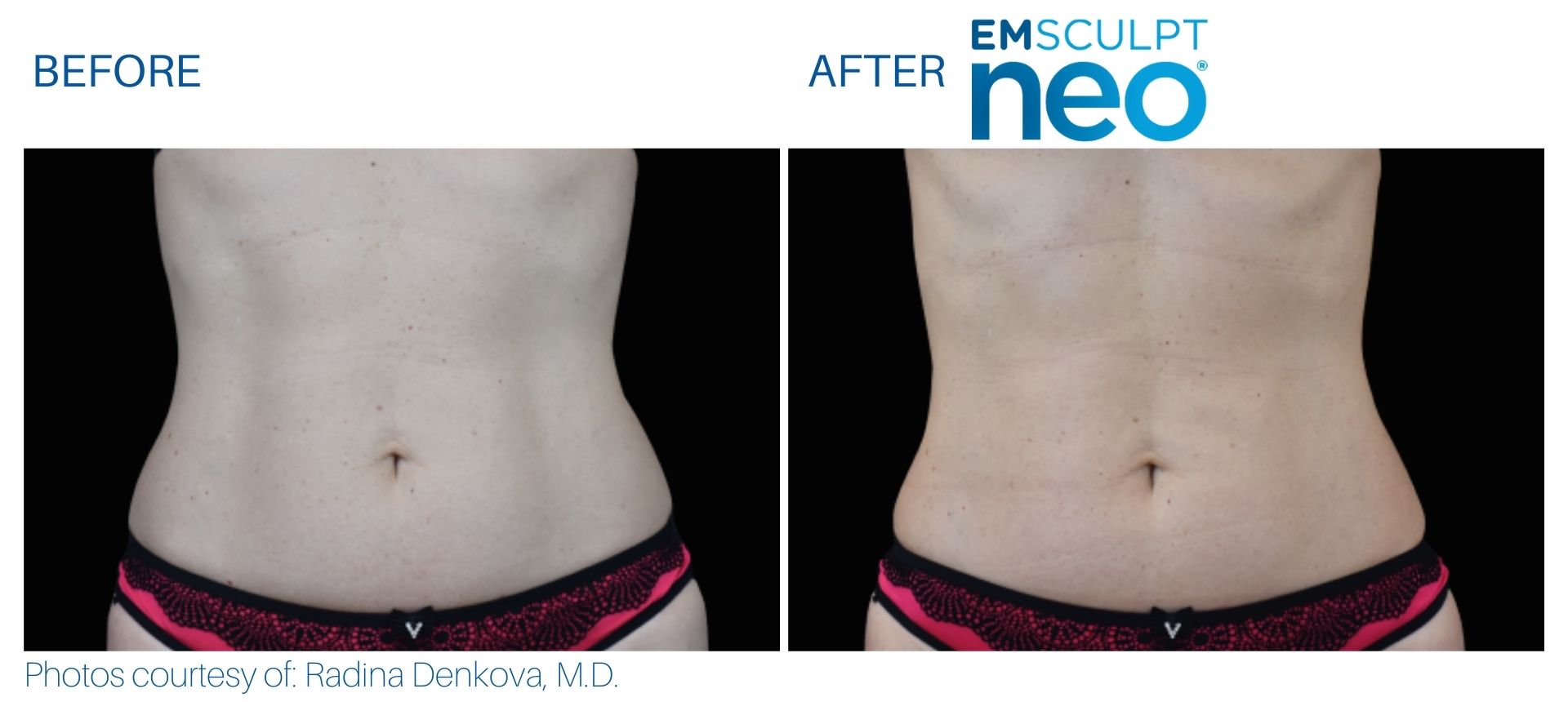 Stomach Before And After Emsculpt Neo Treatment At Optimum Human.