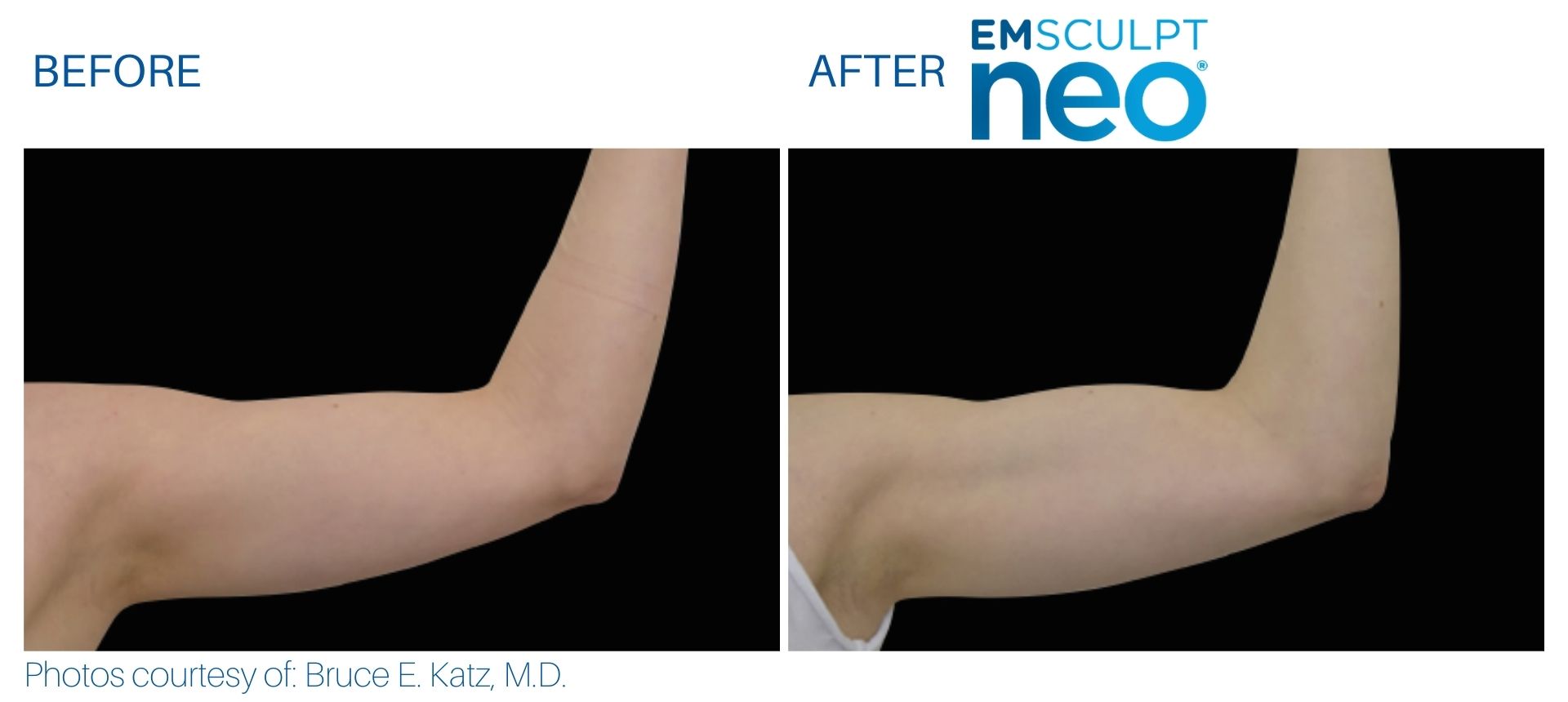 Biceps Before And After Results From Emsculpt Neo Treatments At Optimum Human In Albuquerque, Nm.