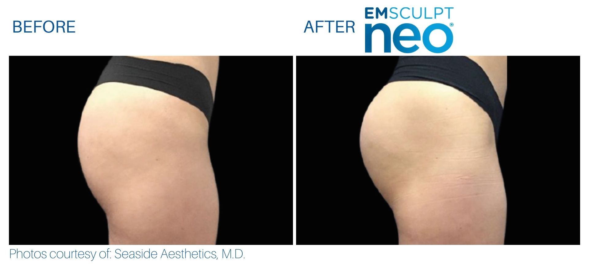 Buttocks Before And After Results After Emsculpt Neo Treatment At Optimum In Albuquerque, Nm.