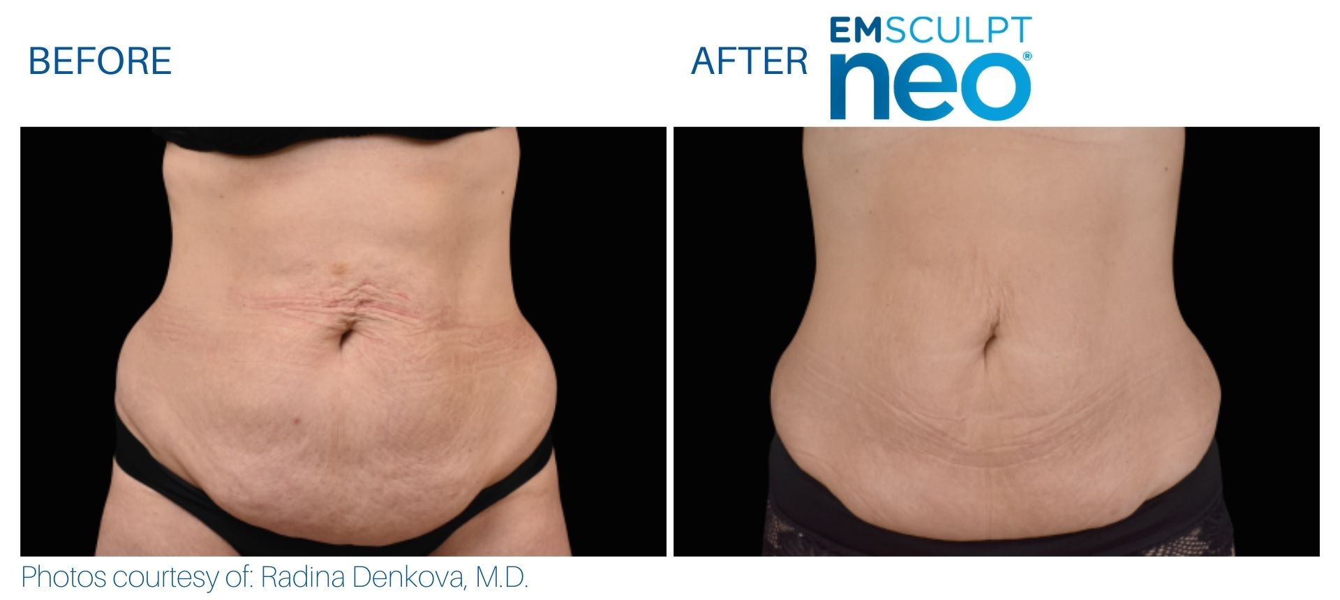 Emsculpt Neo Before And After Of Abdomen Showing Results. Treatments Available At Optimum.