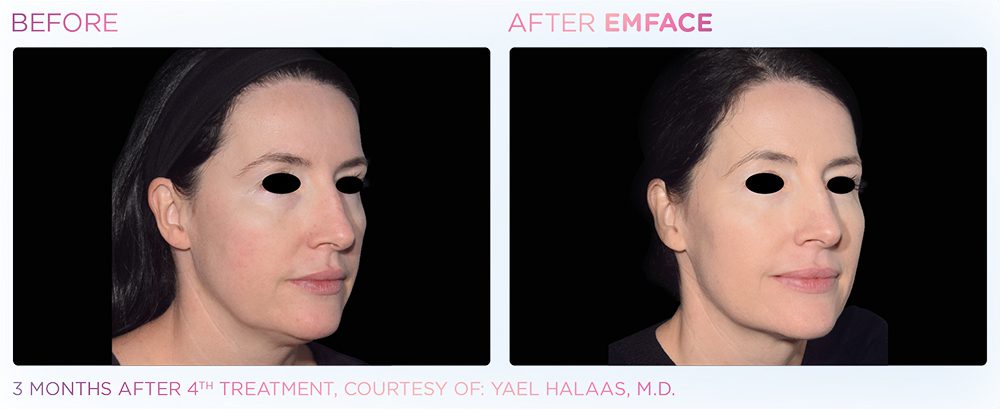 A Woman'S Face Showing Before And After Results Of Emface Treatment At Optimum Human In Albuquerque, Nm.