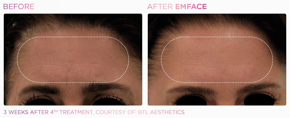 A woman's forehead showing before and after results of Emface treatment at Optimum Human in Albuquerque, NM.