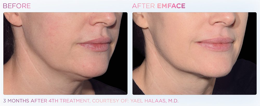 A Client'S Face Showing Before And After Results On The Jawline After Emface Treatment At Optimum Human In Albuquerque, Nm.