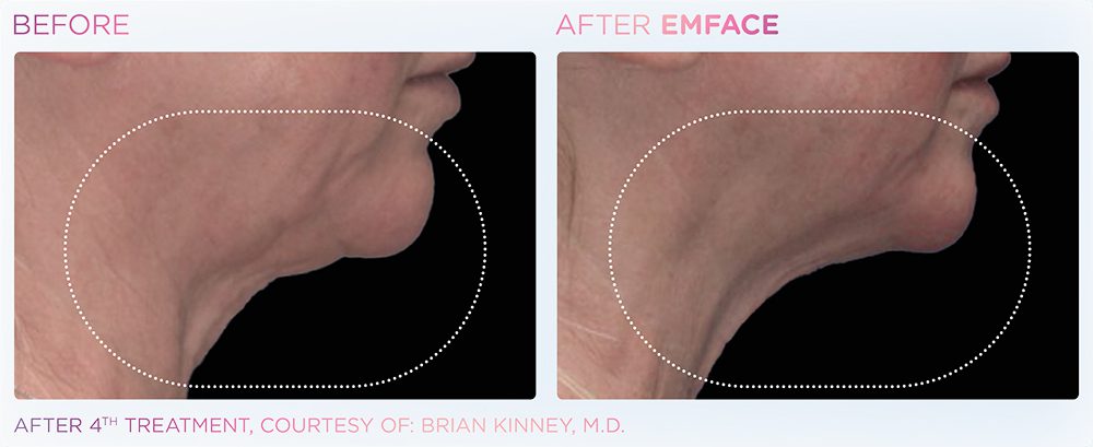 A woman's neck showing before and after results of Emface treatment at Optimum Human in Albuquerque, NM.