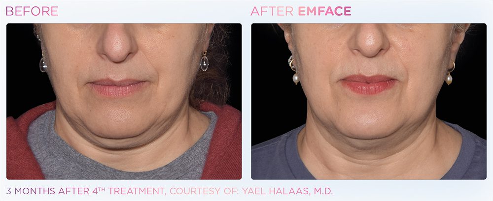 A woman's chin showing before and after results of Emface treatment at Optimum Human in Albuquerque, NM.