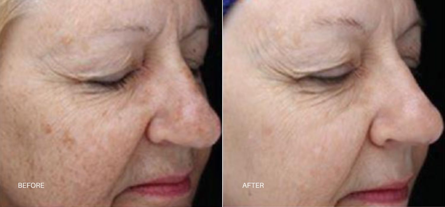 A Woman'S Face Showing Before And After Results Of Forever Body Bbl Hero Treatment At Optimum Human In Albuquerque, Nm.
