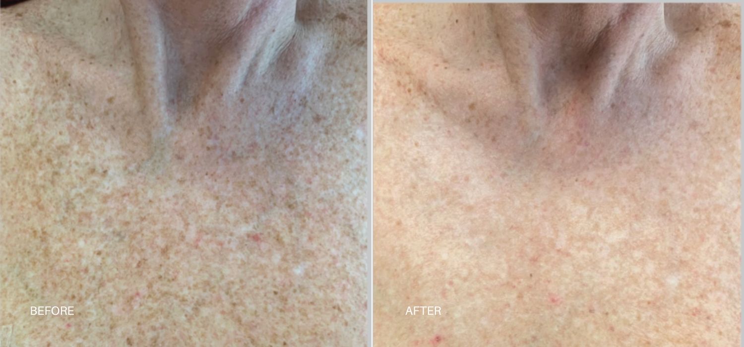 A Woman'S Chest Showing Before And After Results Of Forever Body Bbl Hero Treatment At Optimum Human In Albuquerque, Nm.