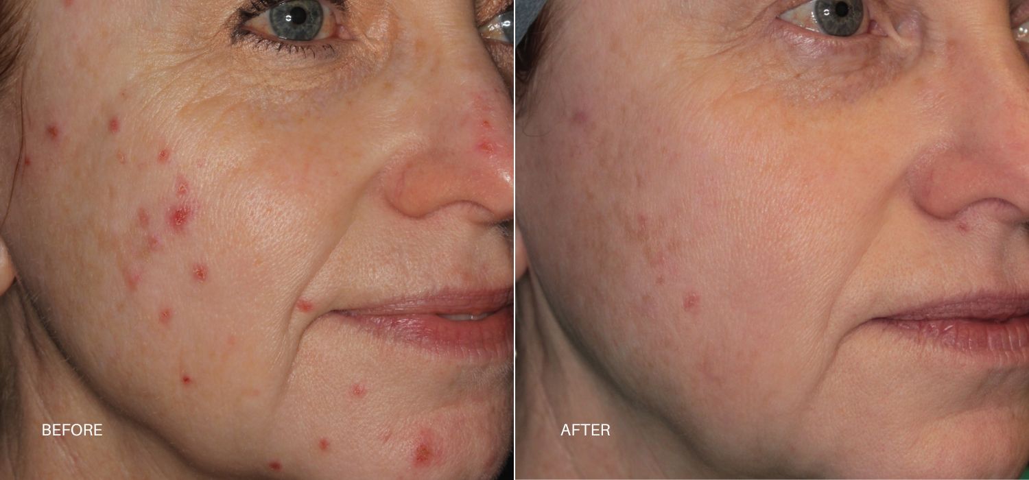 A Young Woman Shows Before And After Results Of Forever Clear Treatment At Optimum Human In Albuquerque, Nm.