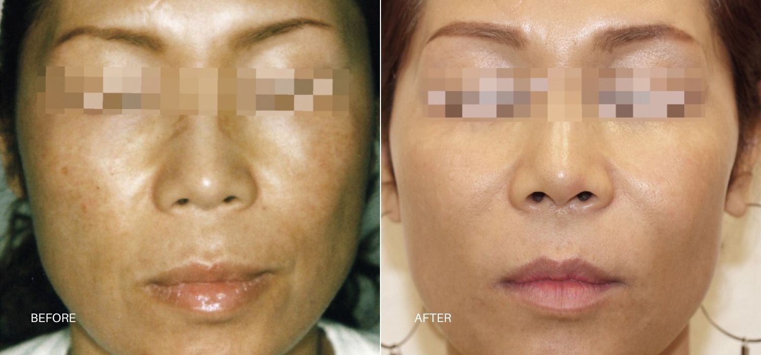 A Woman'S Face Showing Before And After Results Of Forever Body Bbl Hero Treatment At Optimum Human In Albuquerque, Nm.