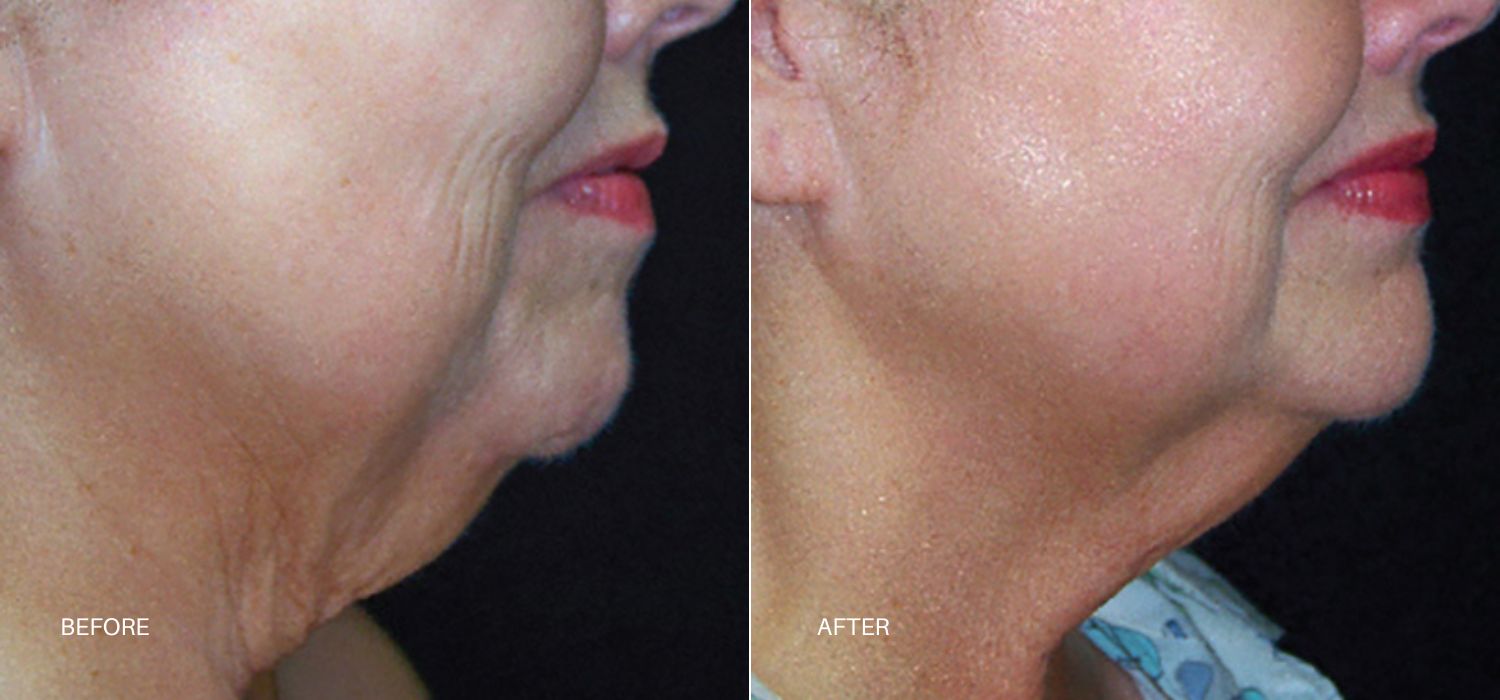 A Woman'S Neck And Chin Showing Before And After Results Of Skin Tyte Treatment At Optimum Human In Albuquerque, Nm.