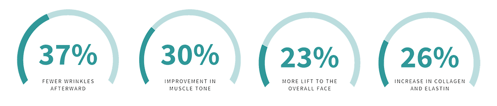 Graphics Showing Increase In Muscle Tone, Fewer Lines And Wrinkles, And Other Benefits Of Emface Treatment At Optimum Health.