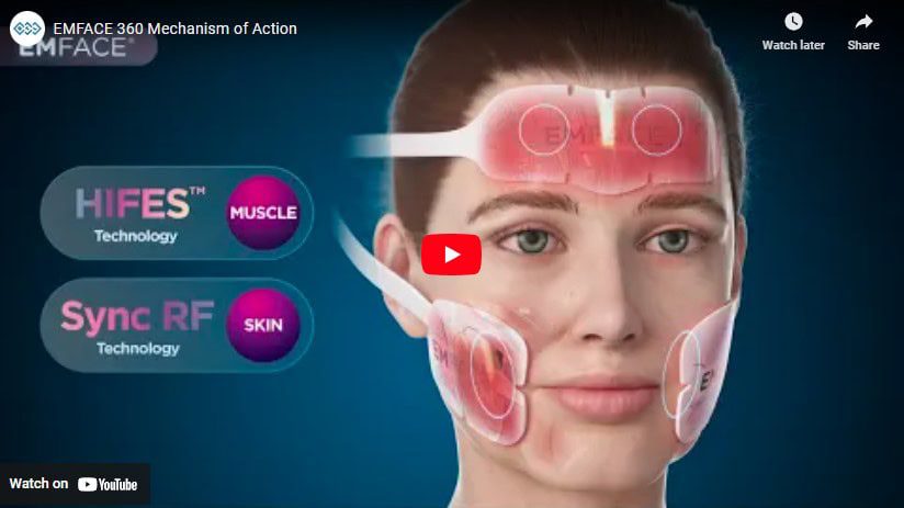 Graphic Showing How Emface Treatment Is Applied And How It Works.