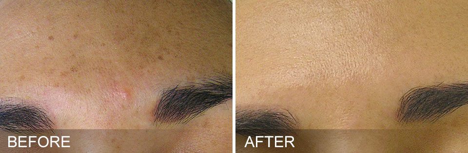 Woman'S Forehead Showing Before And After Results Of Hydrafacial Treatment At Optimum Human In Albuquerque, Nm.