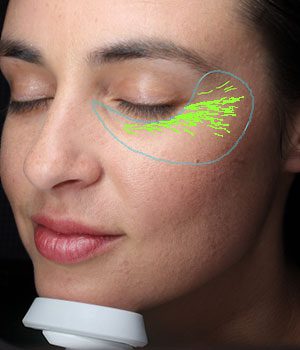 Visia Wrinkles Report
